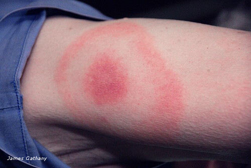borreliose lyme erytheme